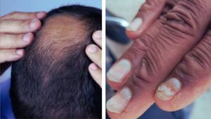 Health Crisis in Buldhana, Maharashtra Sudden Hair and Nail Loss Linked to High Selenium Levels in Wheat