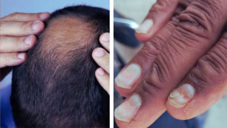 Health Crisis in Buldhana, Maharashtra Sudden Hair and Nail Loss Linked to High Selenium Levels in Wheat