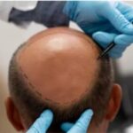 Kanpur Engineer Dies After Hair Transplant; Doctor Booked for Negligence