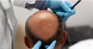 Kanpur Engineer Dies After Hair Transplant; Doctor Booked for Negligence