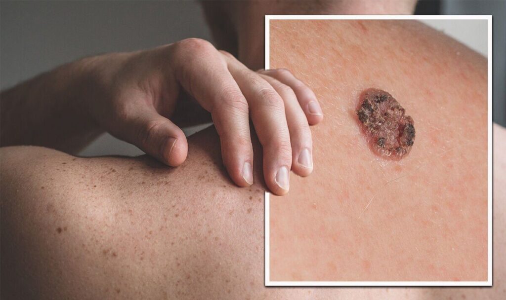 Skin Cancer Cases Rising in India Amid Increased Sun Exposure and Lifestyle Changes