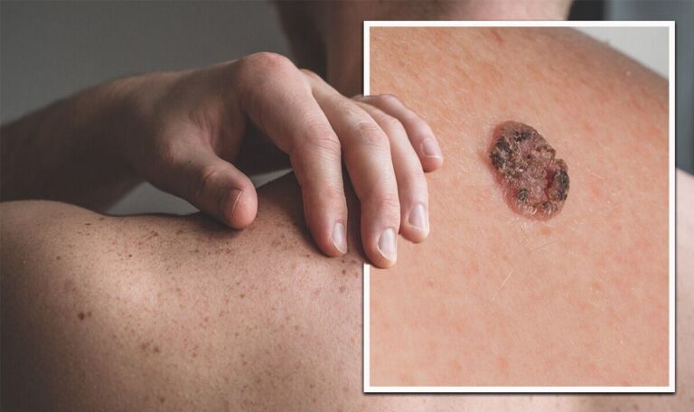 Skin Cancer Cases Rising in India Amid Increased Sun Exposure and Lifestyle Changes